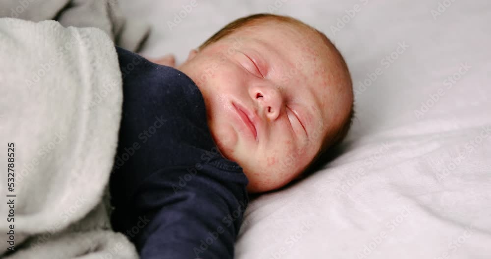 Closeup of baby face skin with pimples and acne from dermatitis.