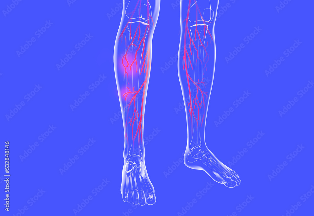 Transparent anatomical 3d illustration of the human legs. Showing the venous system with varicose veins and eczema. Transparent anatomical 3d illustration of the human legs. Showing the venous system with varicose veins and eczema.