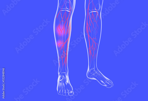 Transparent anatomical 3d illustration of the human legs. Showing the venous system with varicose veins and eczema.