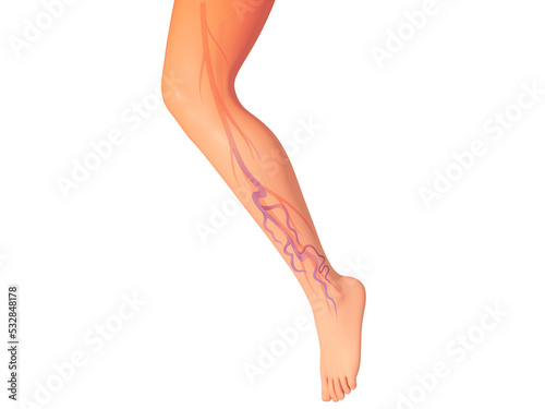 3d illustration of the venous system with varicose veins in one leg. Realistic anatomy representation of the circulatory system. photo