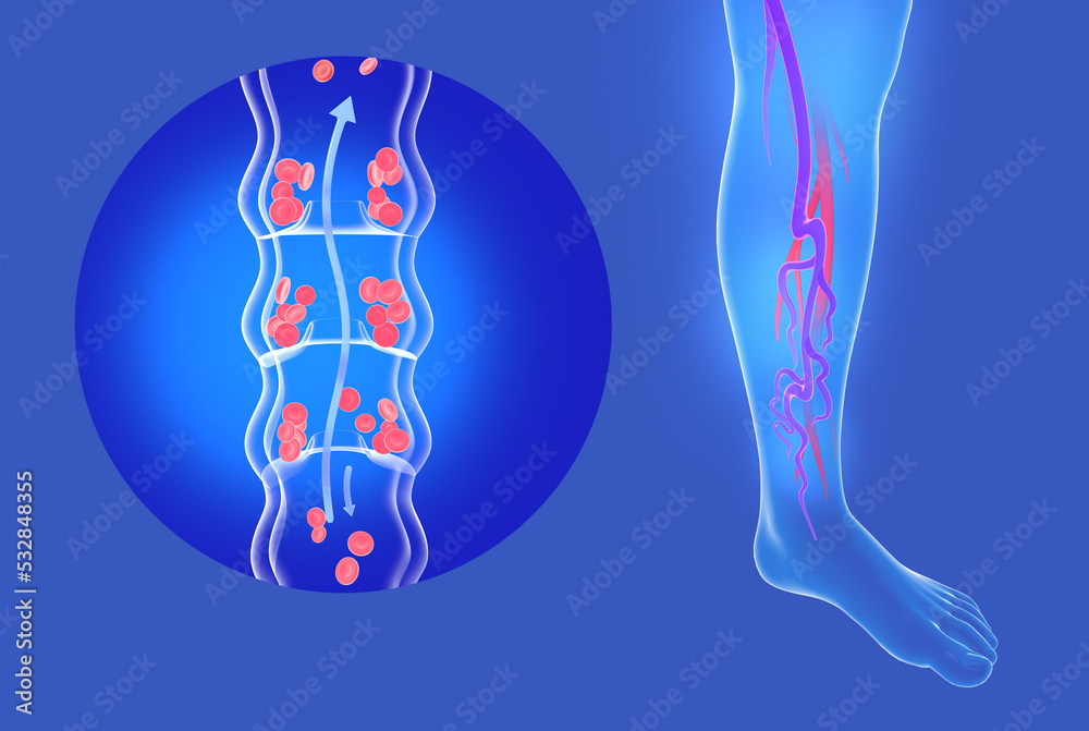 Anatomical 3d illustration of vein and varicose veins in