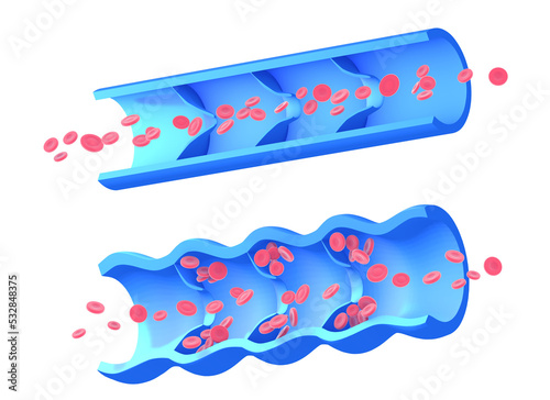 Anatomical 3d illustration of two images, diseased incompetent vein and healthy vein. Graphic representation of the blood circulatory system, on white background. photo