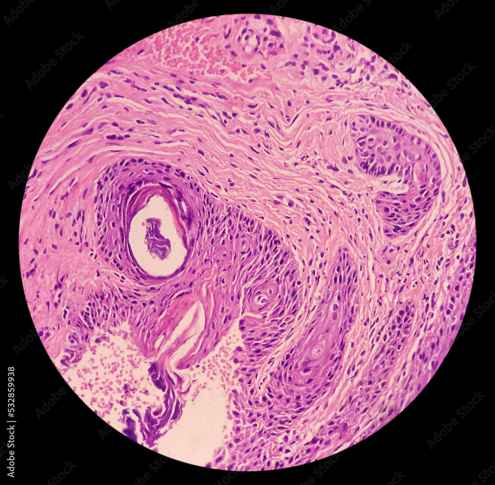 Punch Biopsy of face skin: face skin carcinoma, pigmented basal cell