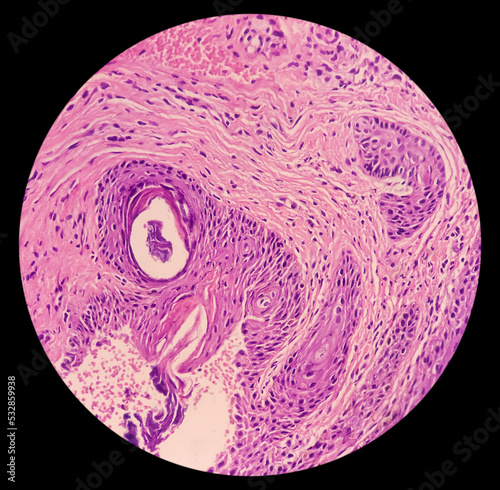 Punch Biopsy of face skin: face skin carcinoma, pigmented basal cell carcinoma, the most common type of sun induced skin cancer. photo