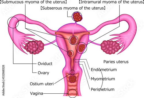 粘膜下筋腫　漿膜下筋腫　筋層内筋腫　イラスト photo