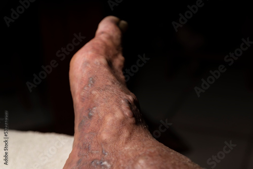 Caucasian man with thrombosed varicose veins on the back of his right foot. photo
