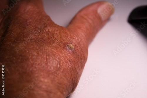 Hand of a 75-year-old Caucasian man with wart or cutaneous horn, which is an outgrowth of compact keratin.