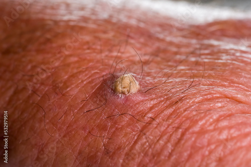 Hand of a 75-year-old Caucasian man with wart or cutaneous horn, which is an outgrowth of compact keratin.