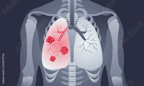 Lung cancer, flat medical Illustration in the lung