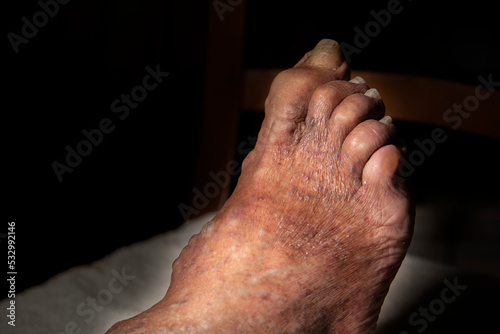 Caucasian man with thrombosed varicose veins on the back of his right foot.