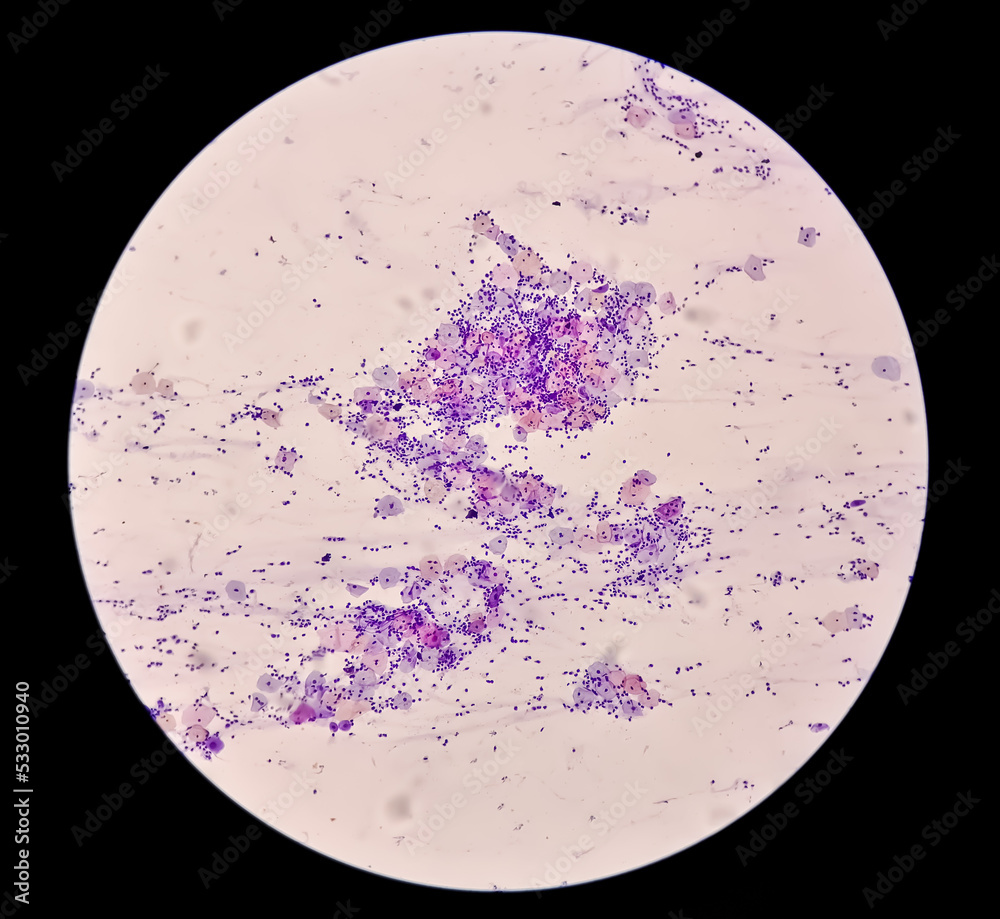 Microscopic view of PAP'S smear showing severe negative for intraepithelial lesion malignancy (NILM). cervical cancer diagnosis. Microscopic view of PAP'S smear showing severe negative for intraepithelial lesion malignancy (NILM). cervical cancer diagnosis.