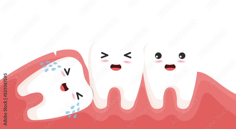 Wisdom tooth push other tooth. Impacted wisdom tooth character pushing