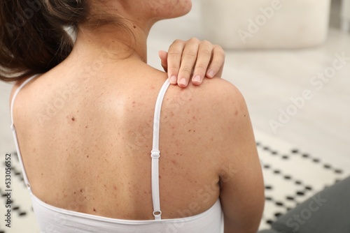 Closeup of woman`s body with birthmarks indoors, back view photo