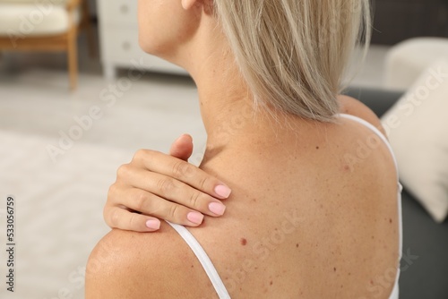 Closeup view of woman`s body with birthmarks indoors photo