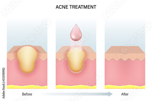 Treatment of acne. Skin layers before, during and after treatment. Acne skin and healthy skin.