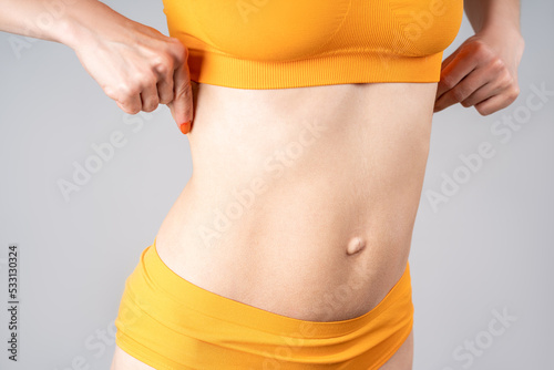 Skinny belly after tummy tuck, plastic surgery concept photo