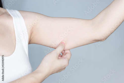Schilderij op canvas Woman is pulling underarm muscle with excess of cellulite