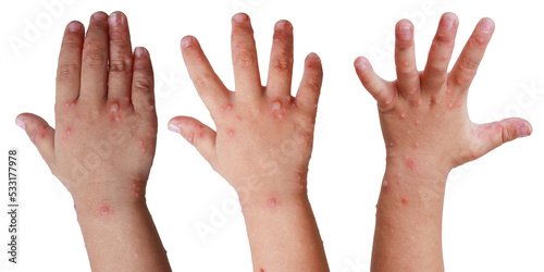 Blister rash on hands of HFMD isolated on white background photo