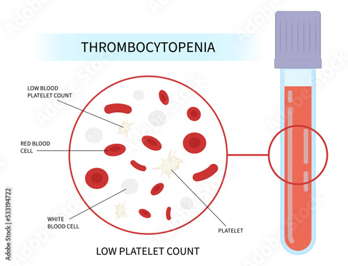 blood disorder and HIV virus decreased complete low platelet count reddish purple spots hepatitis C enlarged spleen alcoholism Alcohol use AIDS nosebleed hematuria bruises red cell