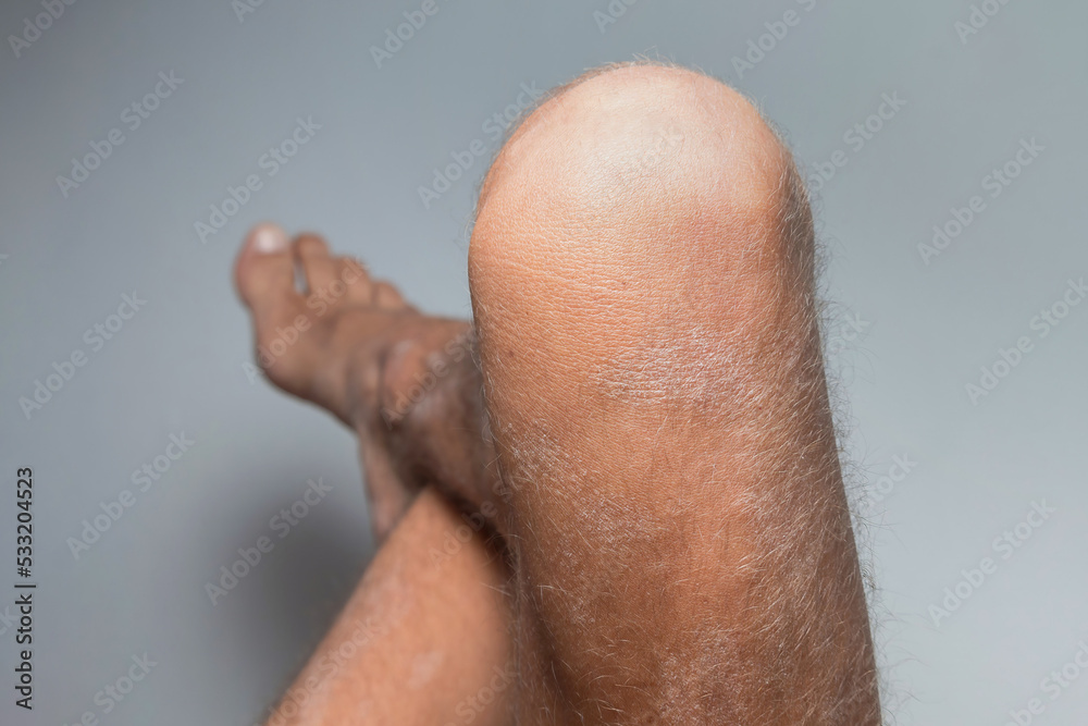 Large plaque parapsoriasis on caucasian man legs Large plaque parapsoriasis on caucasian man legs