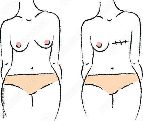Scar from cesarean. Horizontal vertical scar. Breast cancer. Female torso. The medicine. Feminism. Vector graphics. Body.