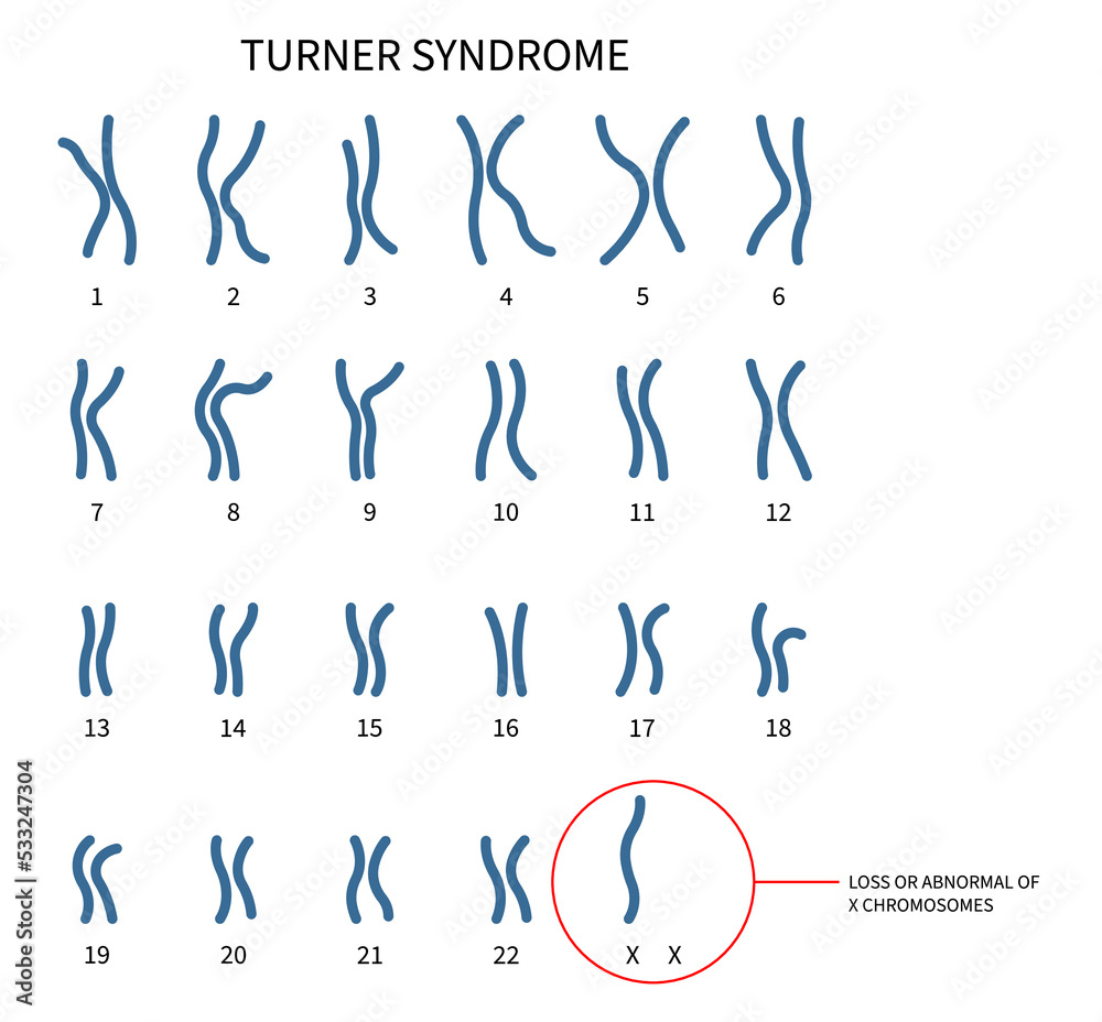 chromosomal disorder Turner and fragile syndrome of the X abnormality