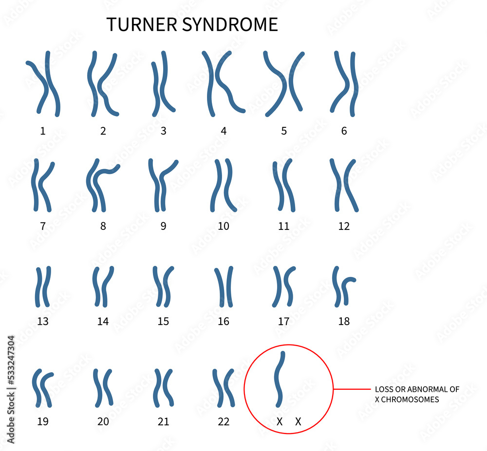 chromosomal disorder Turner and fragile syndrome of the X abnormality test genetic with gonadal dysgenesis in female