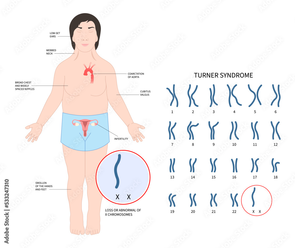 Turner And Fragile Syndrome Of The X Chromosomal Abnormality Test 