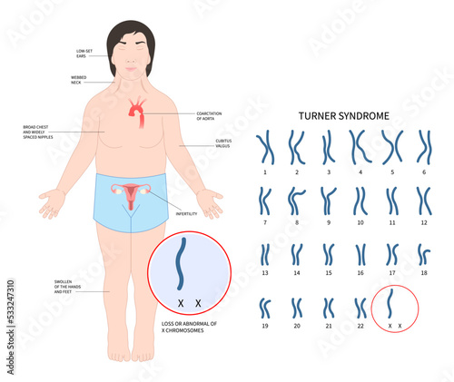 Turner and fragile syndrome of the X chromosomal abnormality test genetic with gonadal dysgenesis disorder in female photo