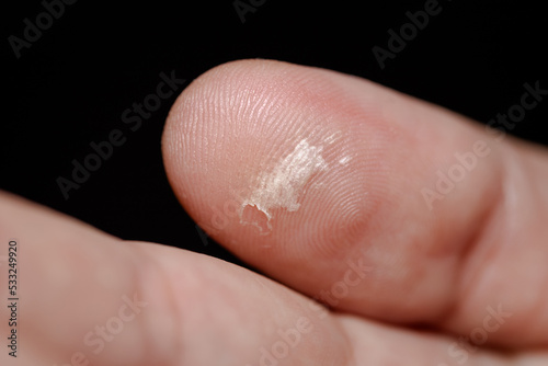 Callus on the thumb of a man. Mechanical damage to the skin. Blister on a man's hand. Problems of dermatology. Black background © hodim