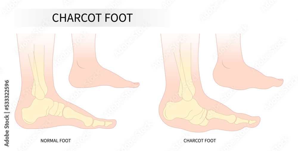 Grafika wektorowa Stock Bone fracture of the Charcot foot anatomy