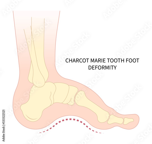 Charcot foot anatomy Bone fracture painful and diabetic gout disease sores leg and Pes Cavus arches of Cavovarus hammer toes