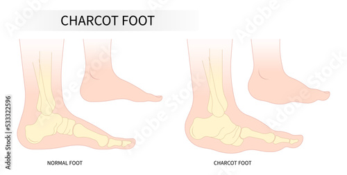 Bone fracture of the Charcot foot anatomy painful and diabetic gout disease sores leg and Pes Cavus arches of Cavovarus hammer toes © Pepermpron