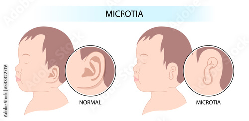 Before and after surgery of Abnormal shape with newborn ear photo