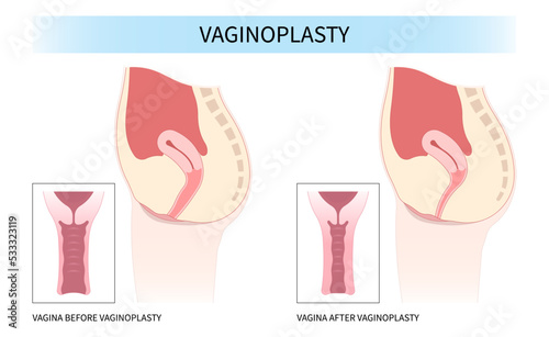 menopause vagina disease Female women genital of minor Vulval labia loose lips beauty surgery to tighten Hood Dry and posterior colporrhaphy reconstruction male by the Vulvoplasty Dyspareunia pain photo