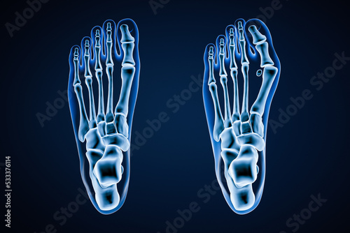Hallux Valgus or bunion x-ray 3D rendering illustration. Dorsal or top view of human healthy and injured left foot on blue background. Anatomy, osteology, pahtology, orthopedics concept. photo