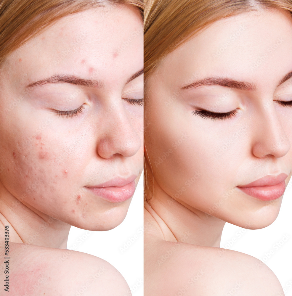 Young woman before and after acne treatment. Young woman before and after acne treatment.