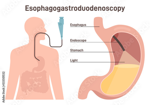 Esophagogastroduodenoscopy. Medical diagnostics of the esophageal, stomach