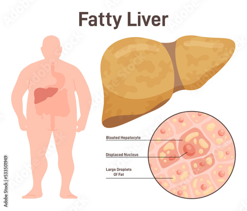 Fatty liver disease, NAFLD. Extra fat in the liver. Overweight person photo