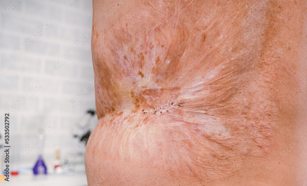 Man with a severe burn all over his body. Close up. Man with a severe burn all over his body. Close up.
