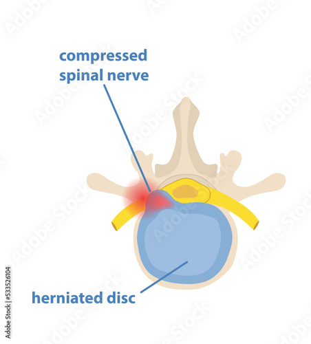 Sciatic nerve pinching concept. Compression of spinal nerve in lumbar spine. Pain from hernia and protrusion. Anatomy, medicine and healthcare. Cartoon flat vector illustration on white background