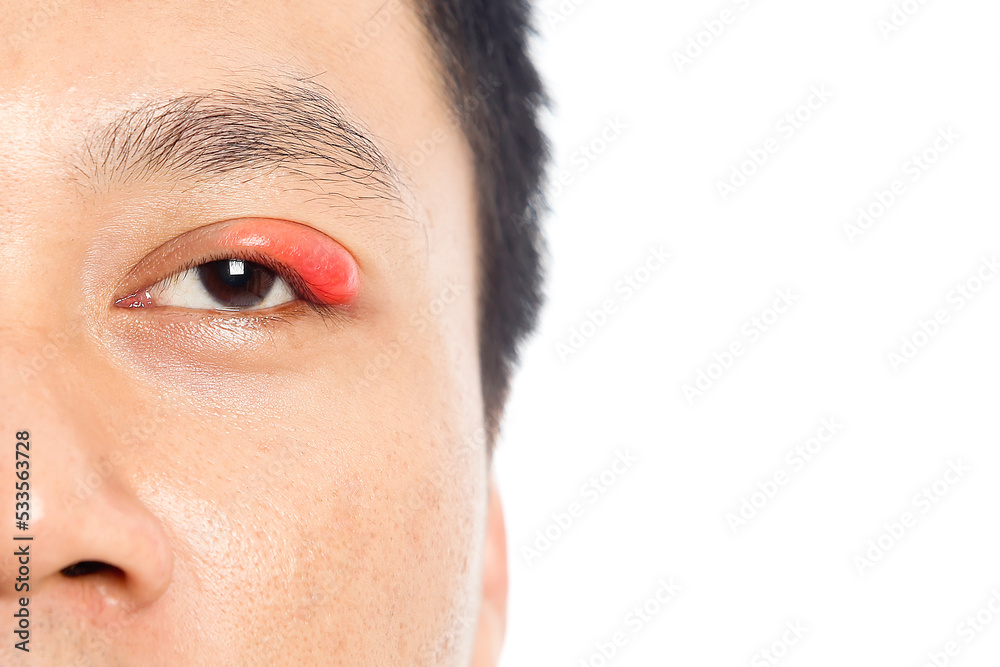 stye on the people eye. bacterial infection in the eyelid.