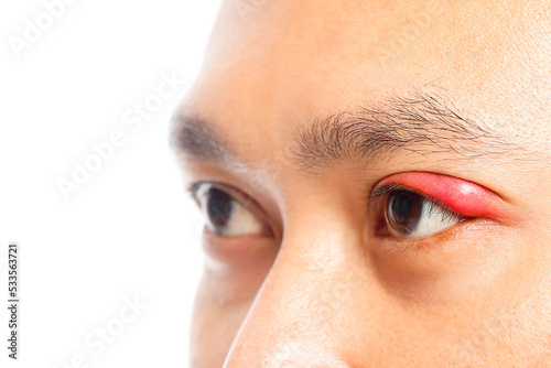 stye on the people eye. bacterial infection in the eyelid. photo