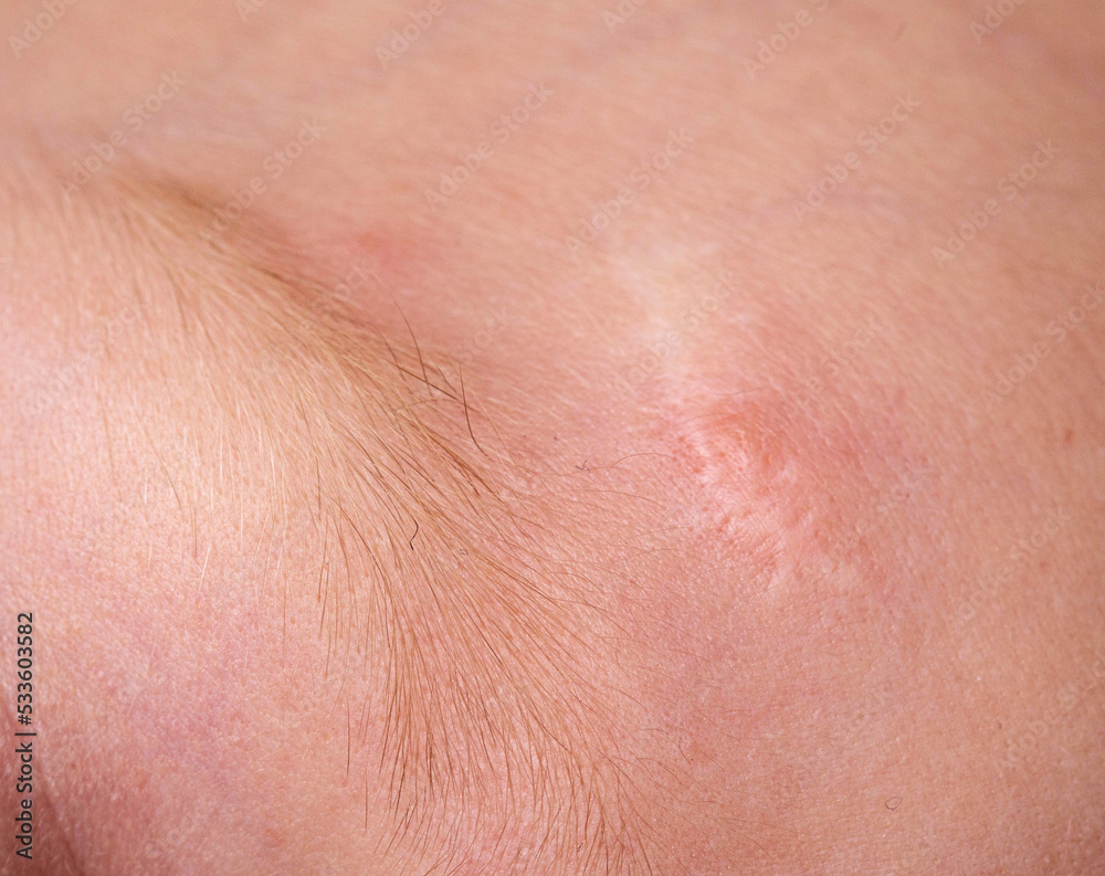 Scar on the forehead on the skin of a child, macro. Medical, laser scar resurfacing.