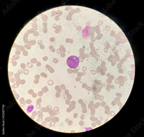 Burkitt's lymphoma cells, is a cancer of the lymphatic system, a monoclonal B-cell tumor. Blast cell Microscopic image photo