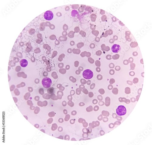 Photomicrograph of Acute Myeloblastic Leukemia (AML), a cancer of white blood cell