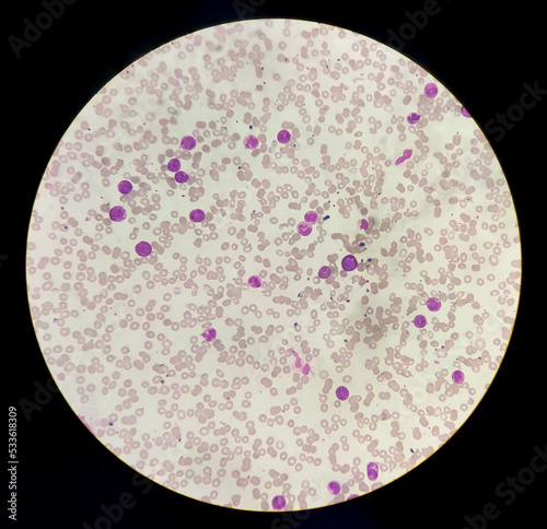 Microscopic image showing Chronic myeloid leukaemia (CML) is a type of cancer, all stage of granulocytic maturation is noted, CML in chronic phase. photo