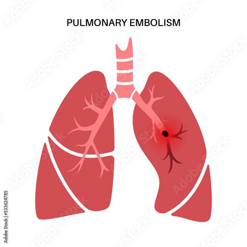 Pulmonary embolism disease