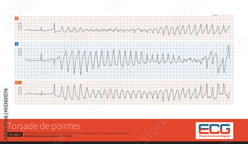 Torsade de pointes refers to the pleomorphic ventricular tachycardia that occurs in the background of long QT interval, and the polarity of QRS wave twists around the equipotential line. photo
