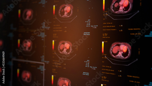 Selective focus of PET-CT imaging showing avid FDG uptake inside myocardium. photo